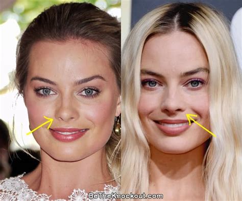 Margot Robbie Before and After Plastic Surgery